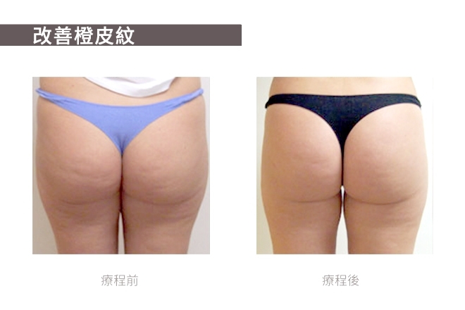 Vela 射頻光學纖體儀器TM_3